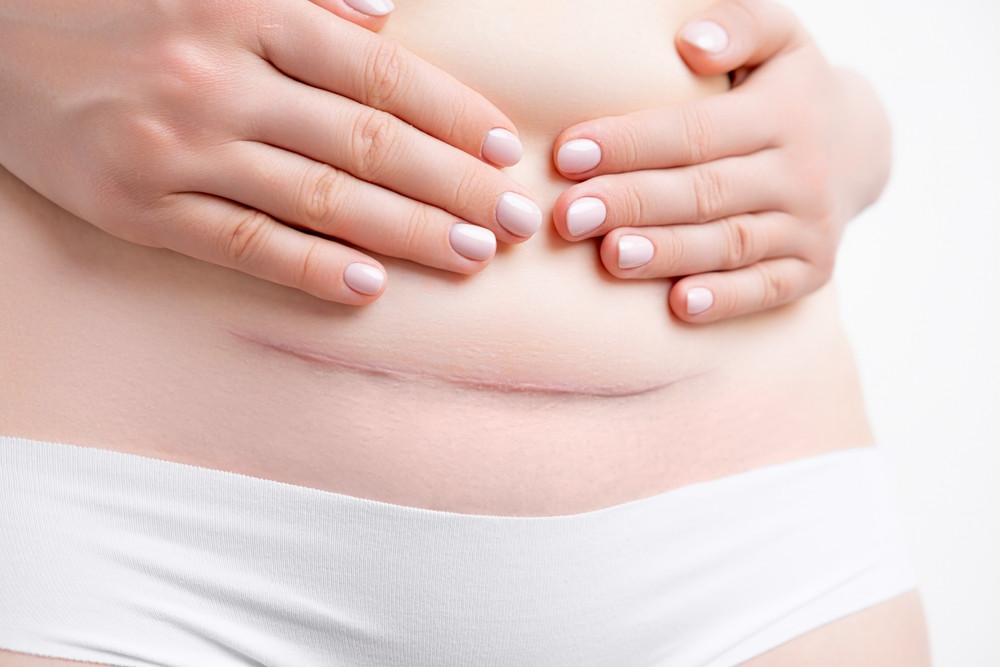 Comment se remettre d’une césarienne ?