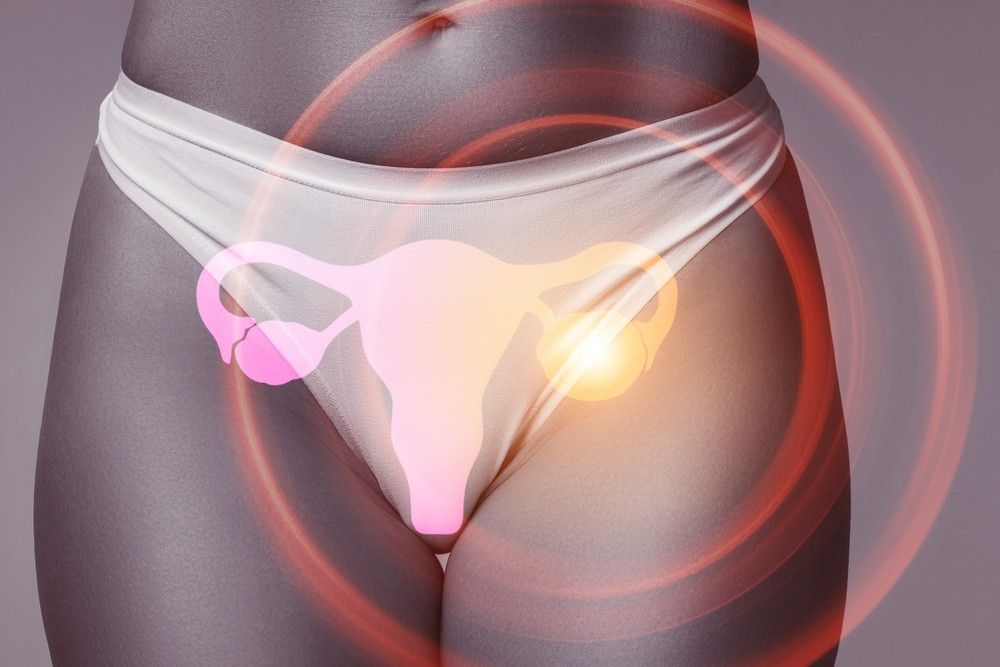 Quels sont les symptômes d’un kyste de l’ovaire ?