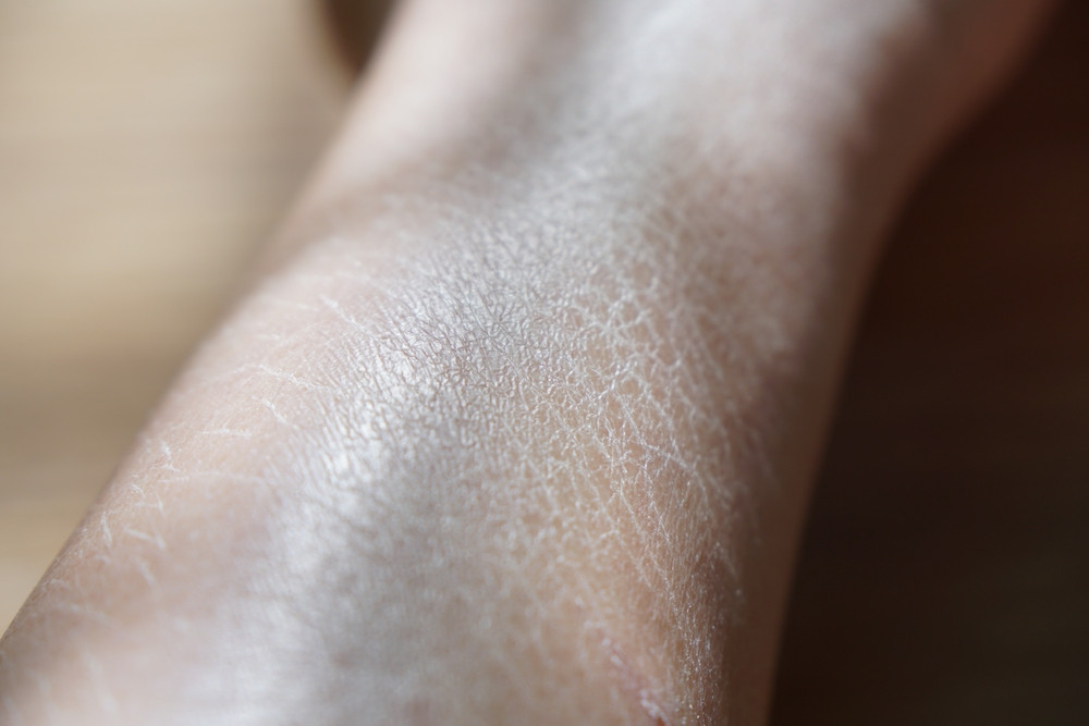 Comment en finir avec la peau de crocodile ?