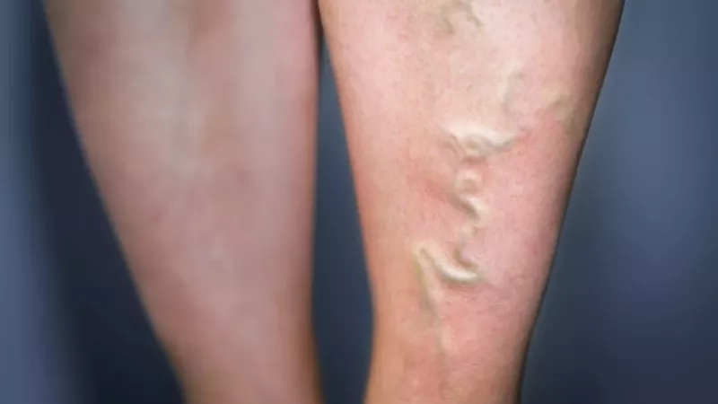 Quels sont les symptômes d'une thrombose veineuse ?