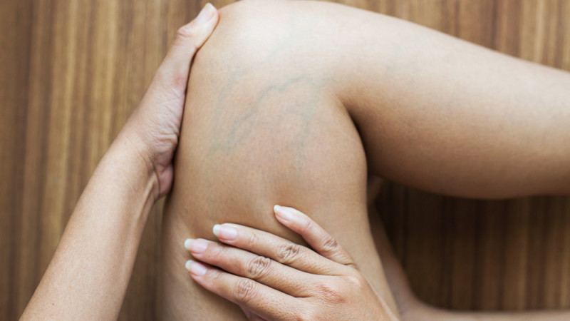 varices