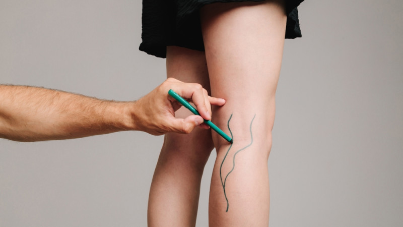 Est-il bon de marcher avec une phlébite ?