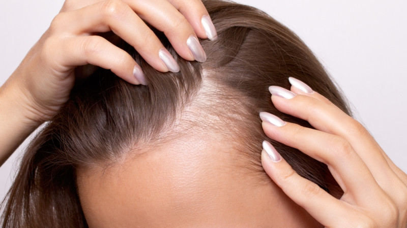 Quelle carence fait perdre ses cheveux ?