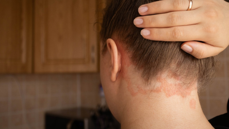 Comment savoir si on fait du psoriasis ?