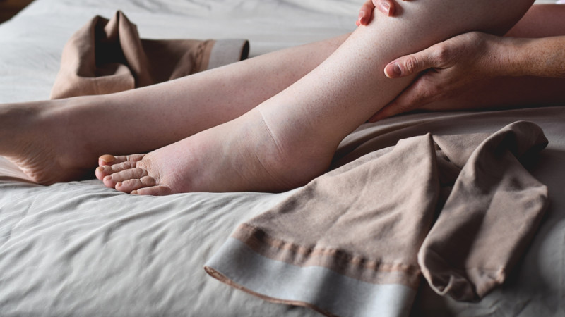 Tout savoir sur l’œdème des jambes
