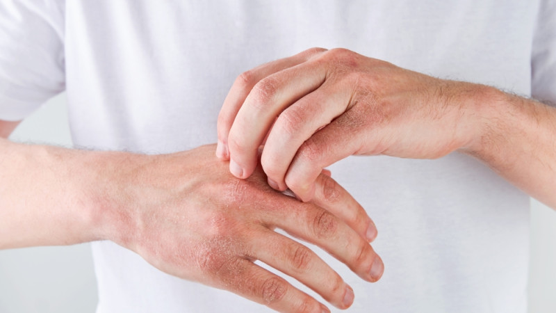 J’ai les mains sèches, que faire ?