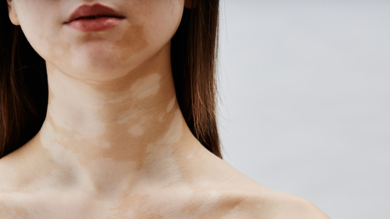 Est-ce que le vitiligo est contagieux ?