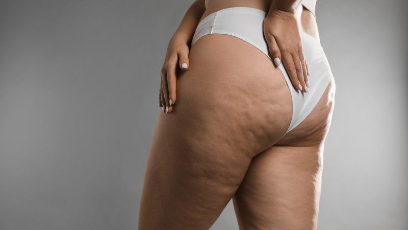 cellulite