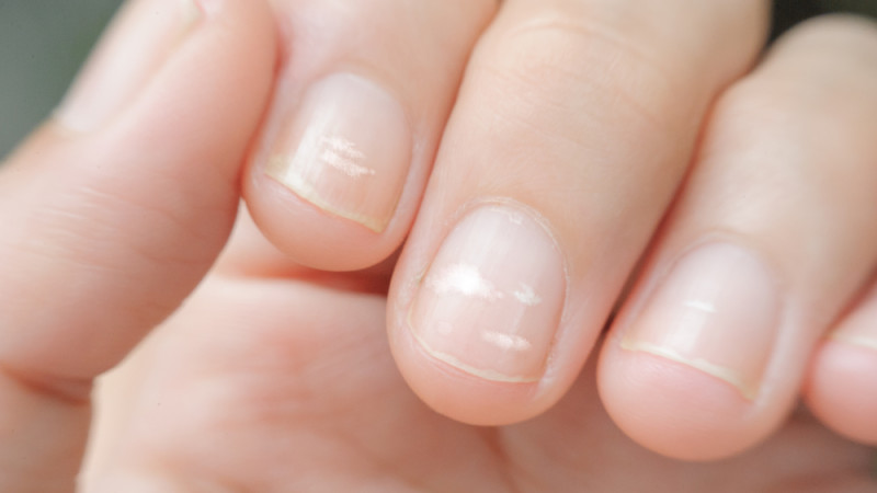Que signifient les taches blanches sur les ongles ?