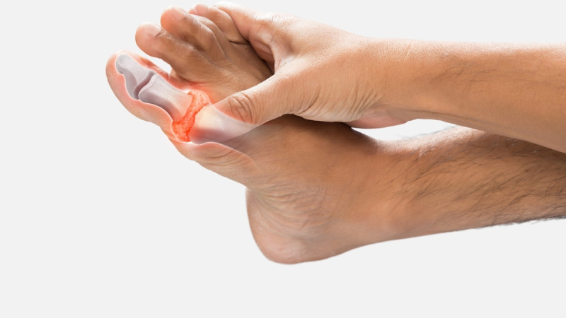Comment faire baisser le taux d'acide urique dans le sang ?