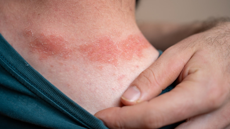Quels sont les signes du psoriasis ?