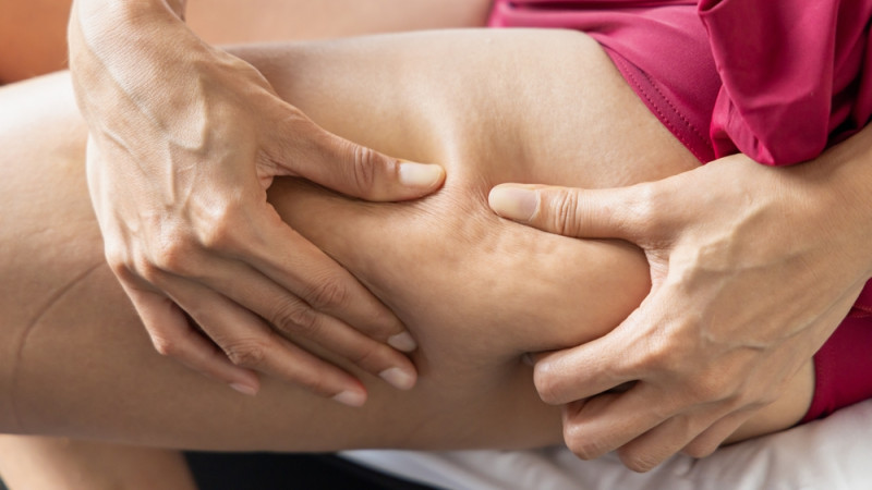 Le sport fait-il disparaître la cellulite ?