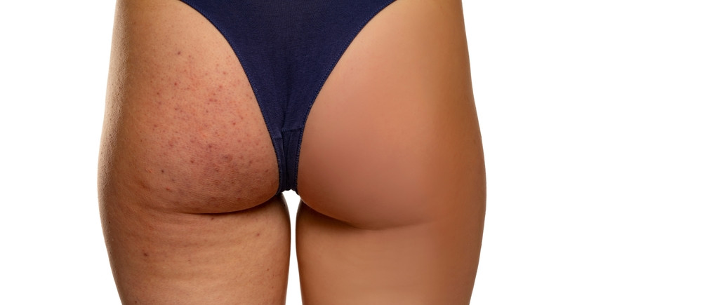 Boutons sur les fesses : comment les traiter ?