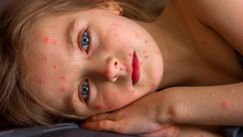 Comment soulager une varicelle ?