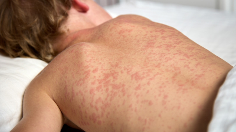 Comment soulager une rubéole ?