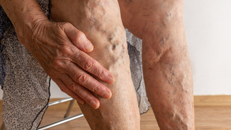Quand s'inquiéter d'une thrombose ?