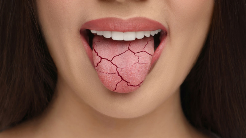 bouche pâteuse