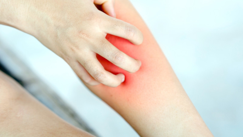 Tout savoir sur le syndrome du mollet qui gratte
