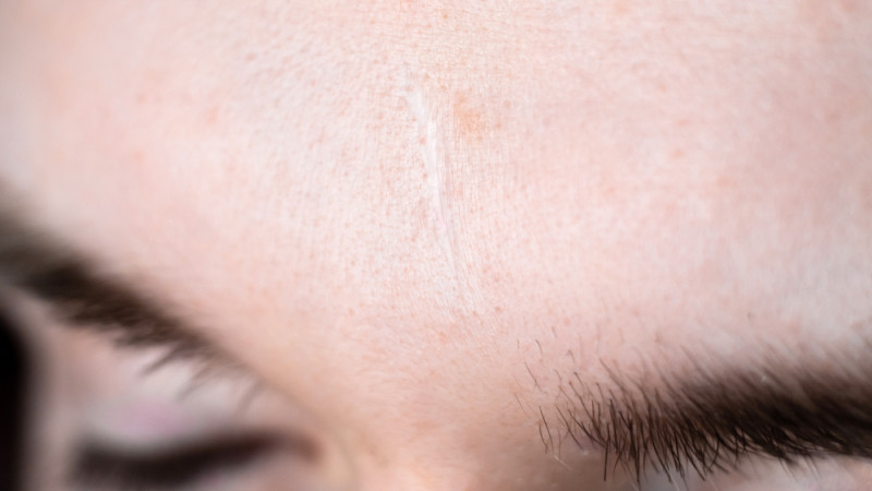 Pourquoi ne faut-il jamais exposer une cicatrice au soleil ?