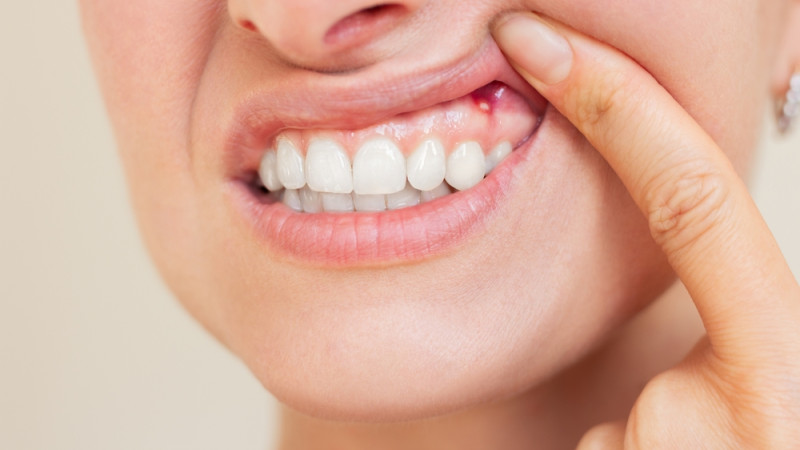 Gencives qui saignent : que faire ?