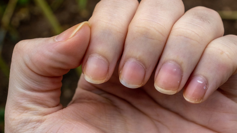 Ongles jaunis : quelles solutions ?