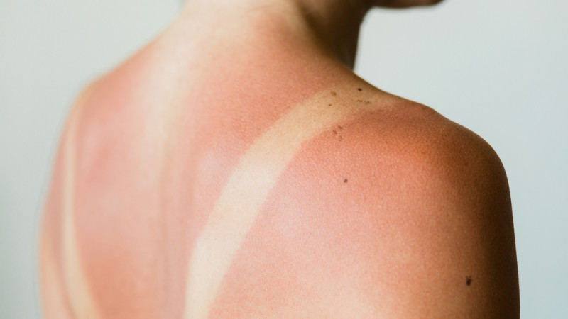 Comment bien dormir après un coup de soleil ?