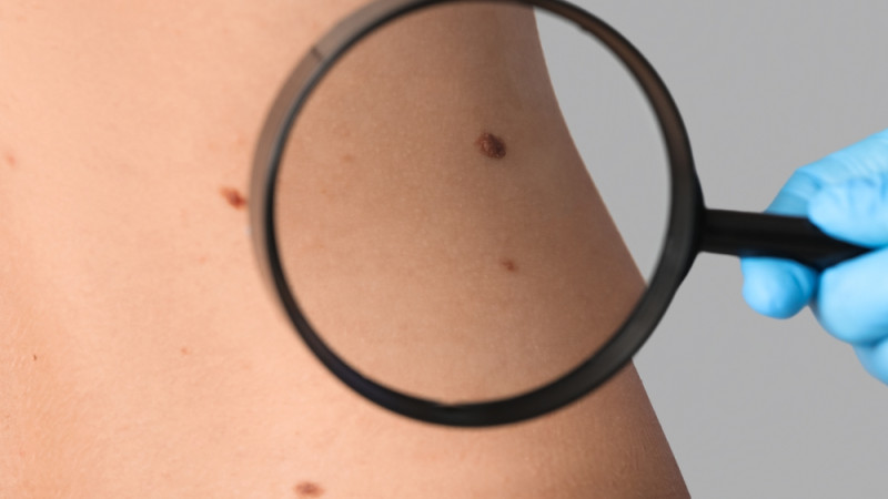 Cancer cutané : quels sont les signes ?