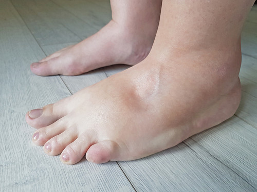 Mes pieds gonflent avec la chaleur : que faire ?