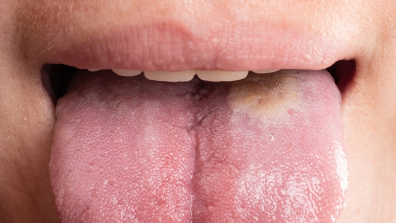Comment réduire les risques de cancer de la langue ?