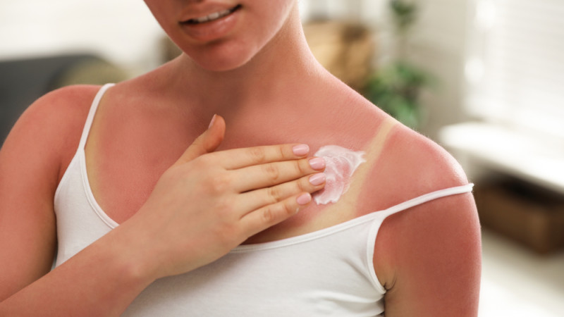 5 remèdes maison contre les coups de soleil