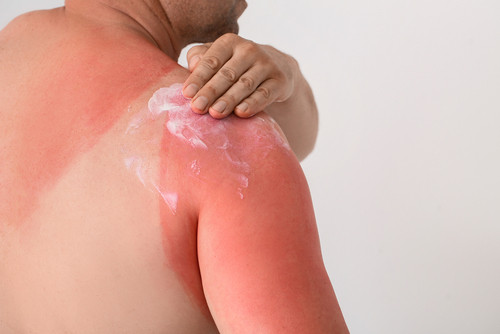 Coup de soleil : combien de temps faut-il attendre avant de se réexposer au soleil ?
