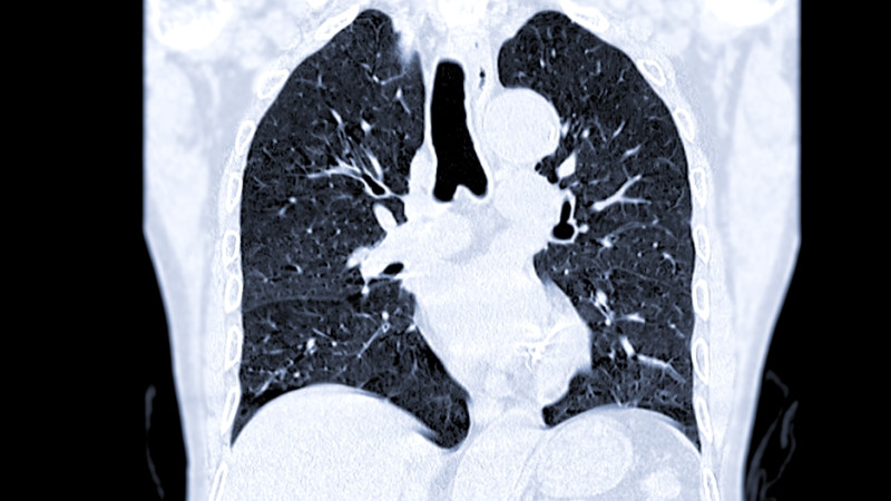 Cancer de la plèvre : quels sont les premiers signes ?