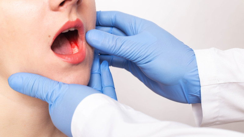Cancer des gencives : quels sont les premiers signes ?