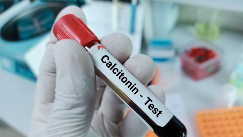 Quel taux de calcitonine est inquiétant ?