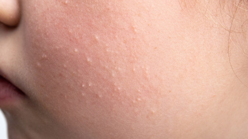 Microkystes : comment se débarrasser de ses boutons sous la peau ?