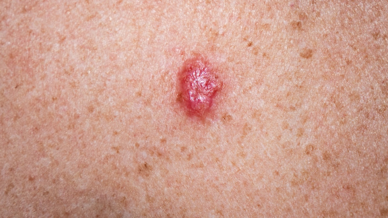 Les premiers signes d’un carcinome