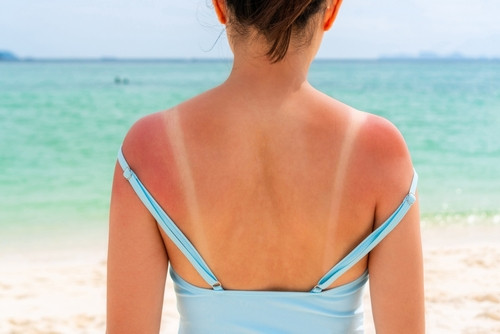 Attention aux burn lines : la tendance dangereuse de l'été