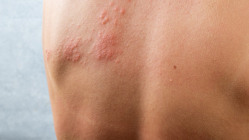 Zona : quels liens avec le cancer ?