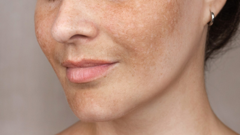 Comment éviter les taches de grossesse ?
