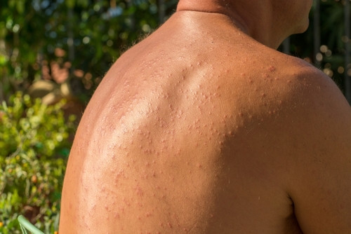 Tout savoir sur l’allergie au soleil