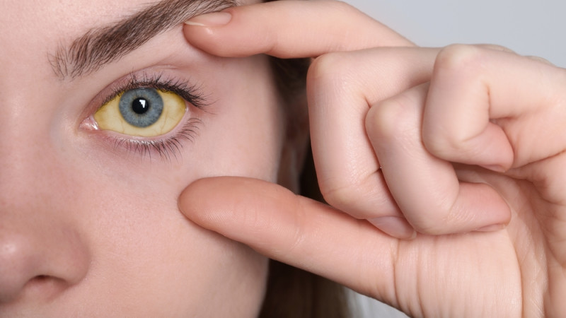 J’ai les yeux jaunes : c’est grave ?