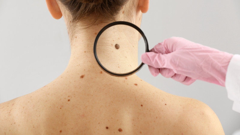 Quelle est l'espérance de vie pour le cancer de la peau ?