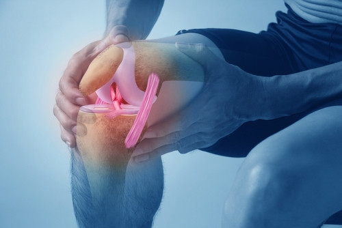 Faire du sport peut-il favoriser l’arthrite ?