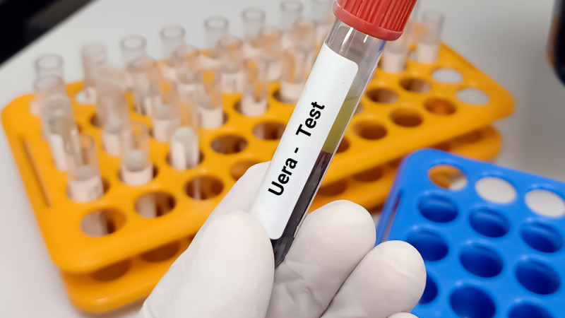 Comment faire baisser mon taux d’urée ?