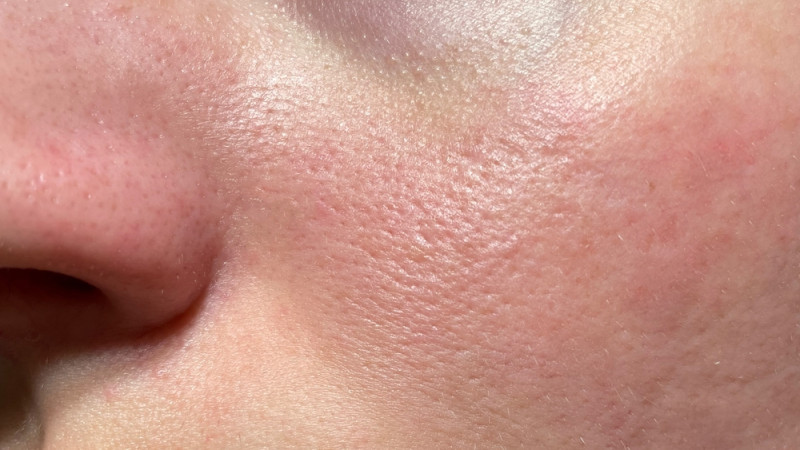 Comment lutter contre les rougeurs au visage ?