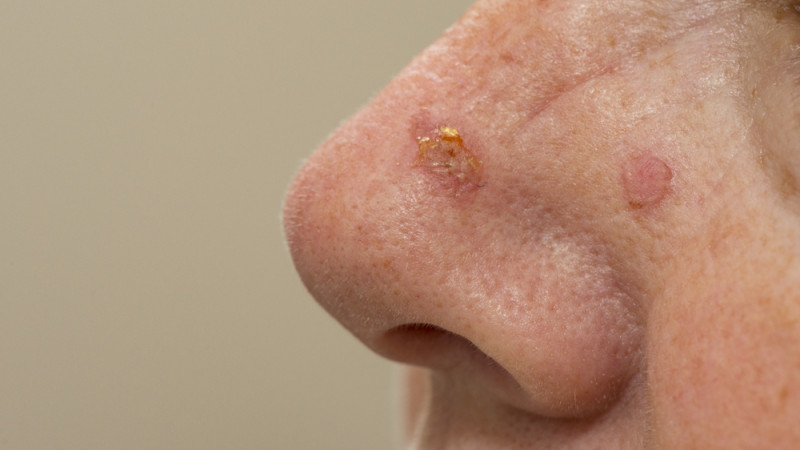Cancer du nez : quels sont les premiers signes ?