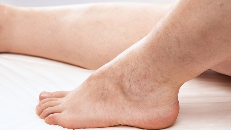 C’est quoi l’insuffisance veineuse chronique ?