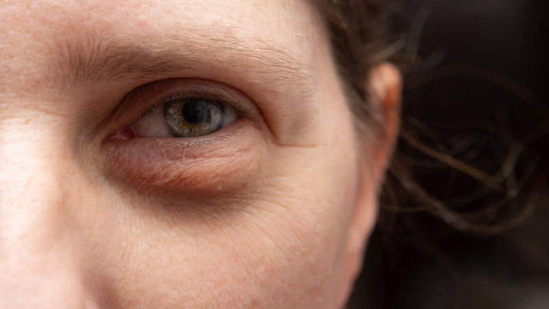 Poches sous les yeux ? Nos solutions