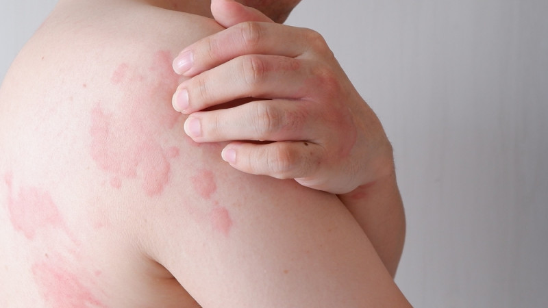 Intolérance à l’histamine : quels aliments éviter ?
