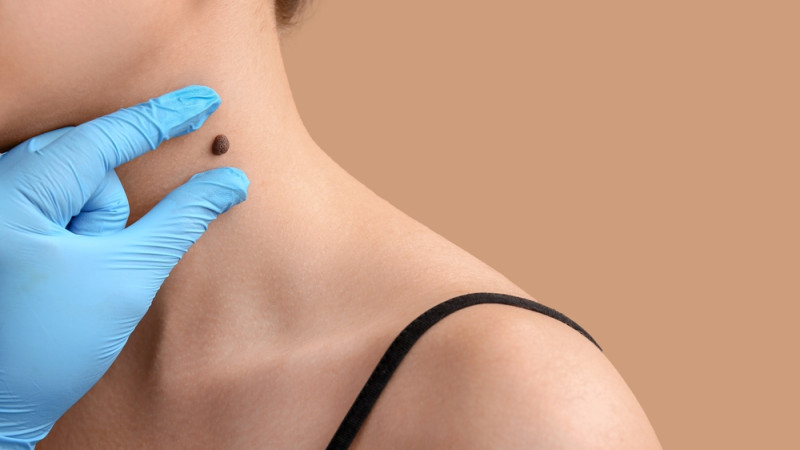 10 symptômes où il faut rapidement consulter un dermatologue